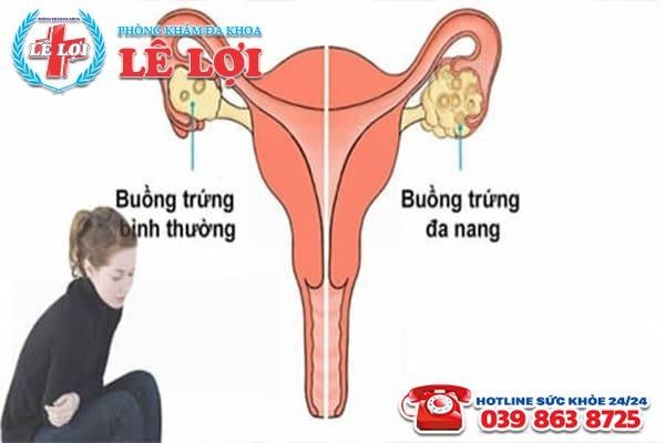 Bệnh đa nang buồng trứng ở nữ giới